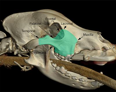 Excision of Extensive Orbitozygomaticomaxillary Complex Tumors Combining an Intra- and Extraoral Approach With Transpalpebral Orbital Exenteration